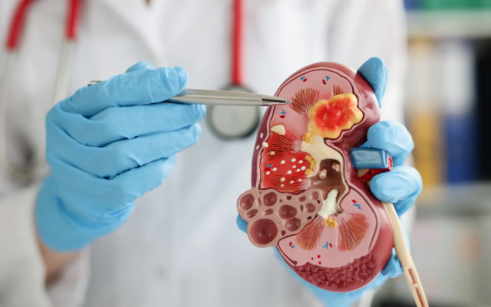 Kidney Stone Surgery