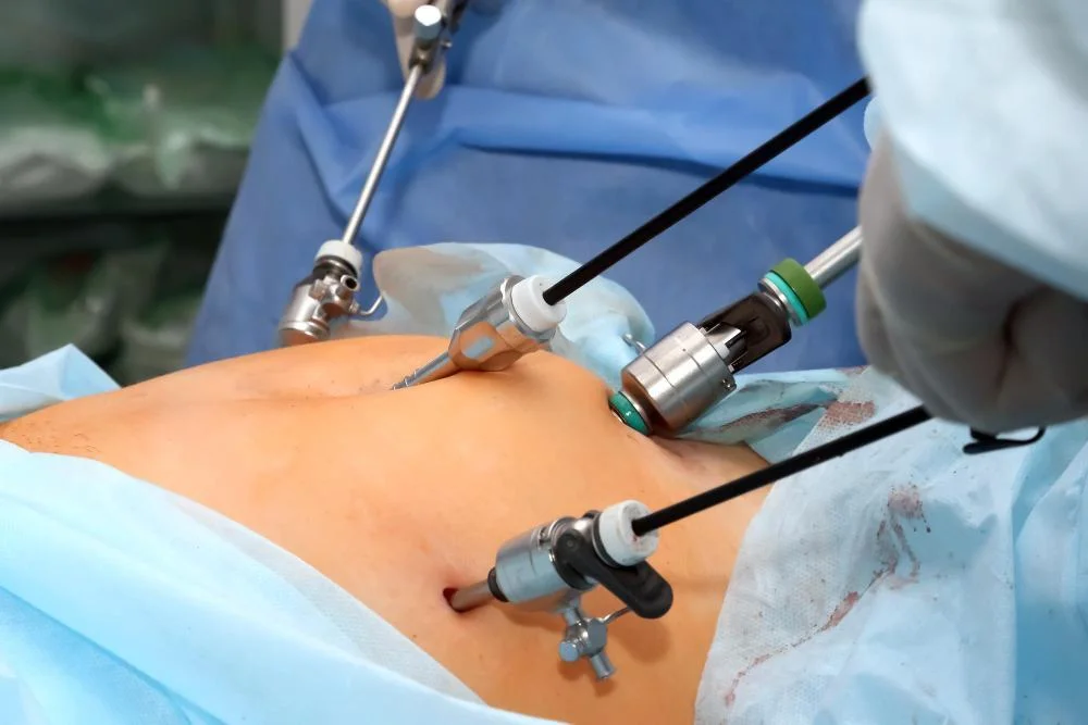 Appendix Surgery (Appendectomy)