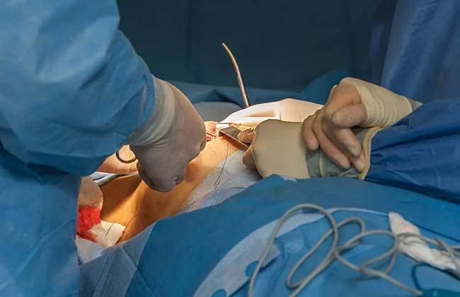 breast-lump-surgery