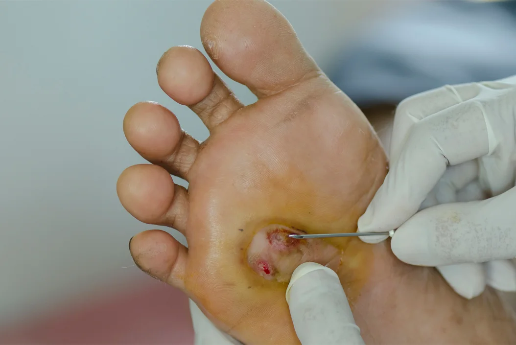 Diabetic Foot Care & Surgery