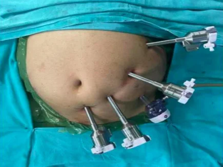 Laparoscopic Surgery