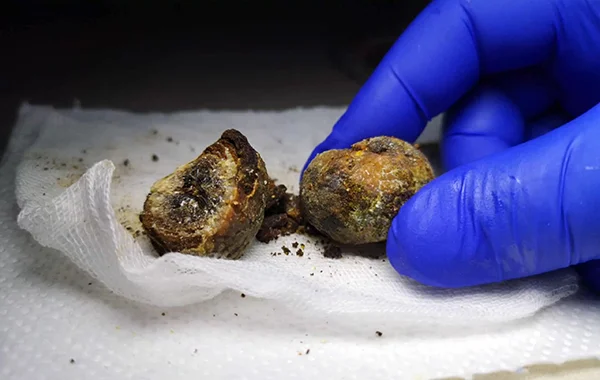 Gallstone Surgery (Cholecystectomy)