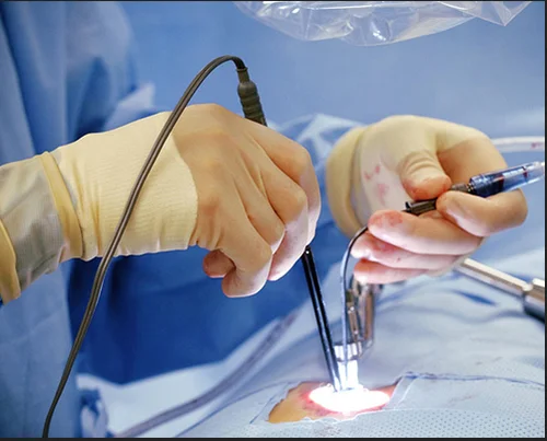 Laser Piles Treatment (Proctology)