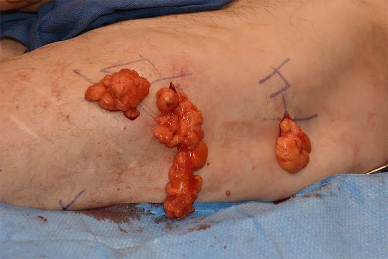 Lipoma Removal Surgery