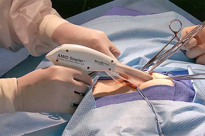 Stapler Surgery (Hemorrhoidopexy)