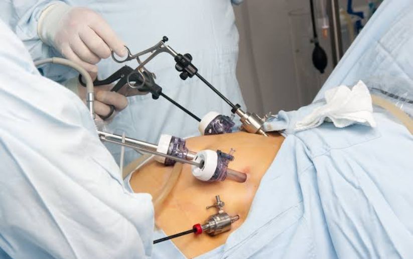 Gallstone Surgery