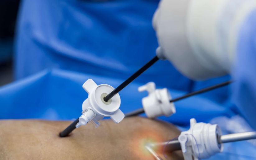 Gallstone Surgery