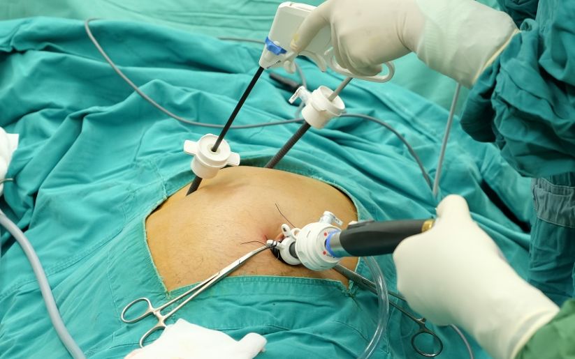 Gallstone Surgery