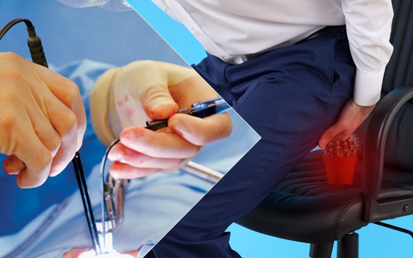 Laser Piles Treatment