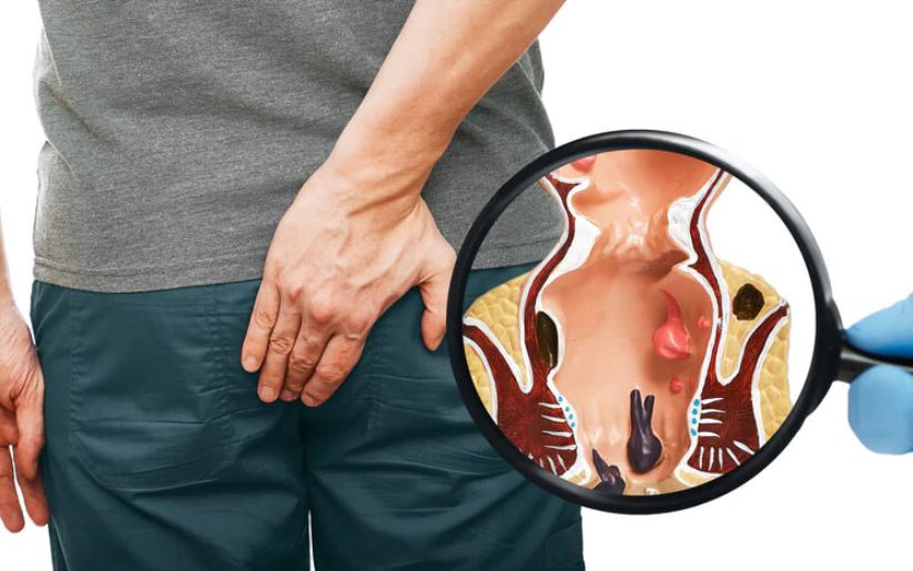 Laser Piles Treatment