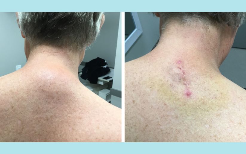Lipoma Removal Surgery