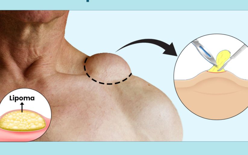 Lipoma Removal