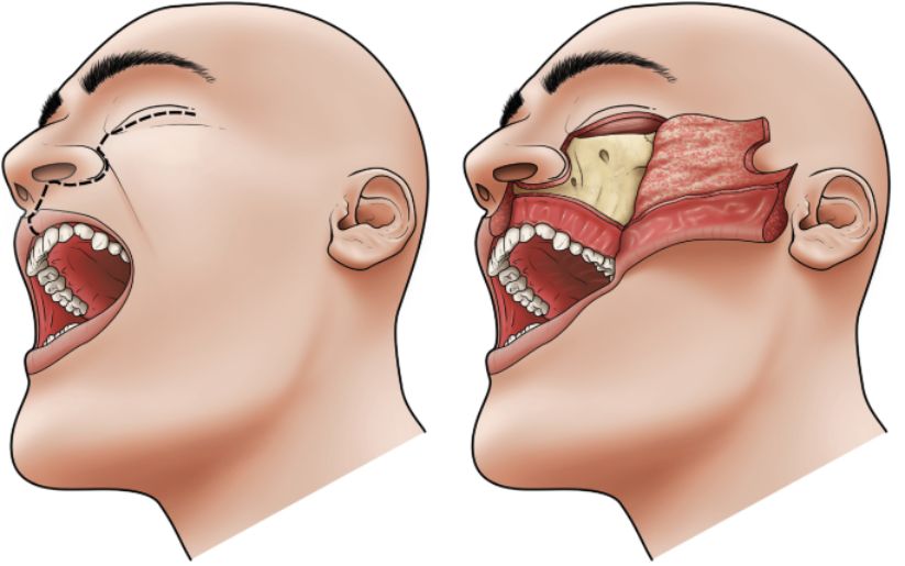Oral Cancer Surgery