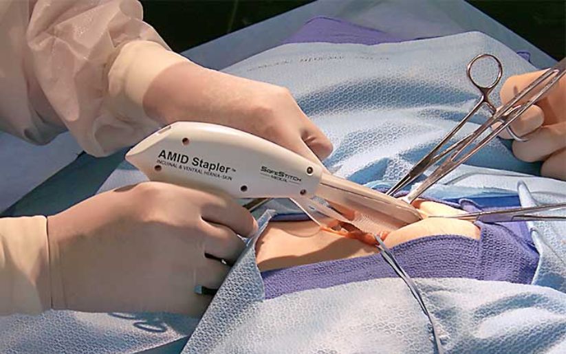 Stapler Surgery